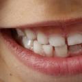 The meaning of dreams about tooth loss
